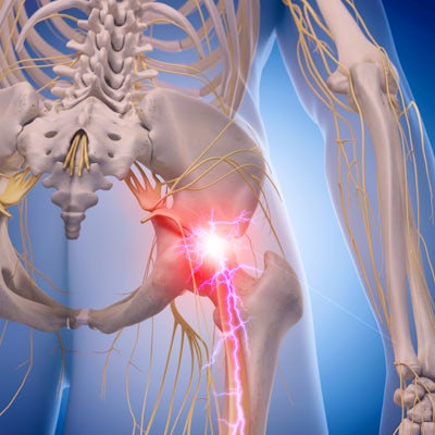 medical illustration of inflamed sciatic nerve